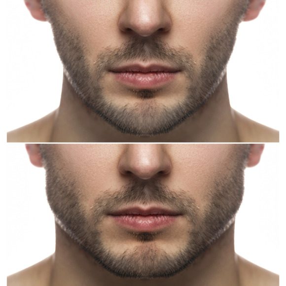 Masculinización facial
