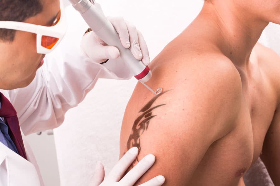 Remoción de tatuajes